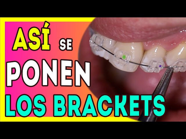 Discover how transparent braces are put on, a professional method explained step by step