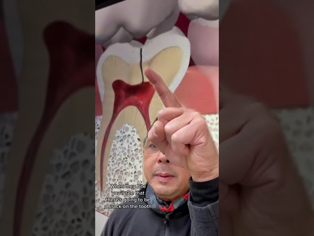 Understanding Toothache from a Cracked Tooth | In Office to Hands On Dental Training
