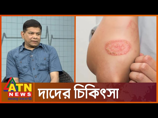 দাদ হলে  কী করবেন?  | Skin Desists | Ringworm |  Health Tips | ATN News