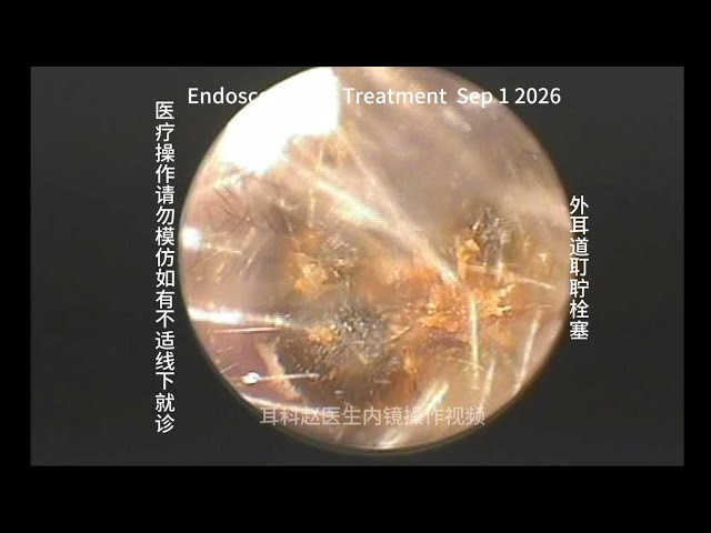 Clearing a Case of Severe Earwax Impaction 20260901