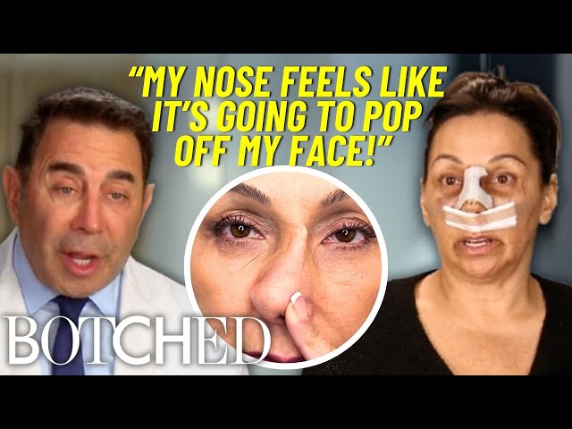 Will Renee's Nose FALL OFF After 3 Botched Rhinoplasties?! *FULL TRANSFORMATION* | Botched | E!