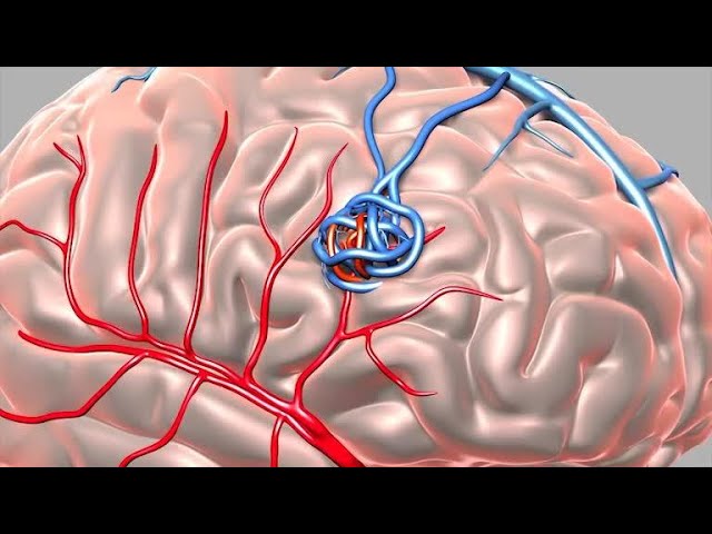 Arteriovenous Malformation (AVM)
