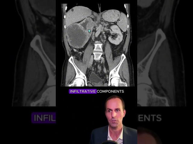 Renal cell carcinoma CT interpretation #radiology #medicalstudent #radiologist #radiographer