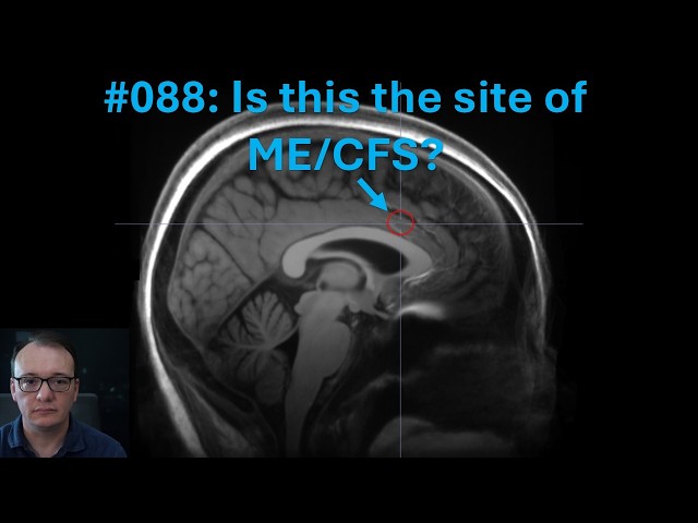 088 - Is this the site of ME/CFS? (It is not about motivation or willpower)