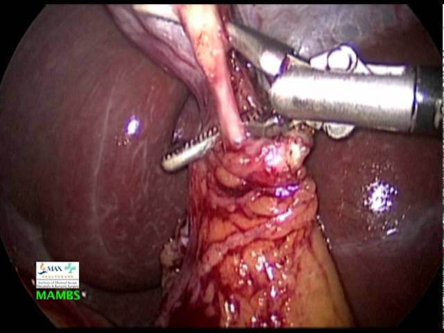 Laparoscopic Cholecystectomy -gallbladder removal by Max Hospital