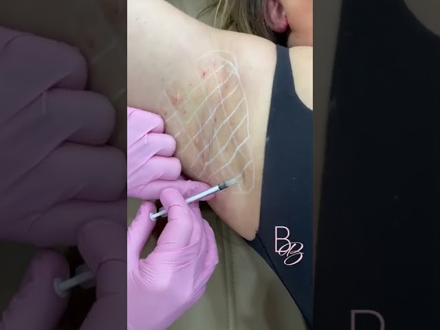 Worried about those sweaty underarms? 😥 Here's the ultimate botox hack! 💦