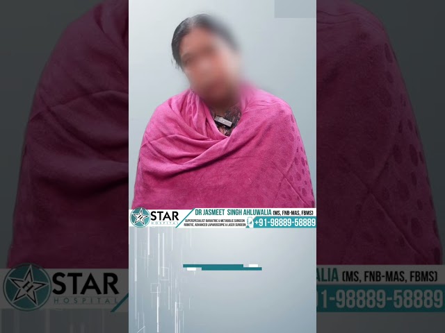 Gallbladder Stone Removal Surgery Patient Testimonial | Mini Laparoscopic Surgery#gallbladdersurgery