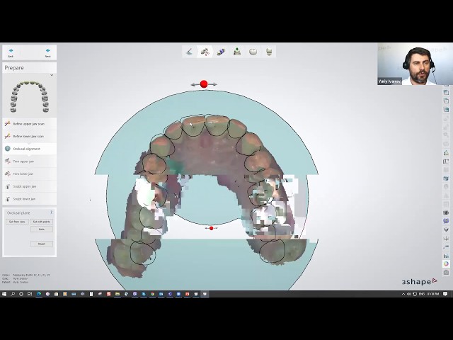 3Shape Digital Wax-up Mock Up Technique