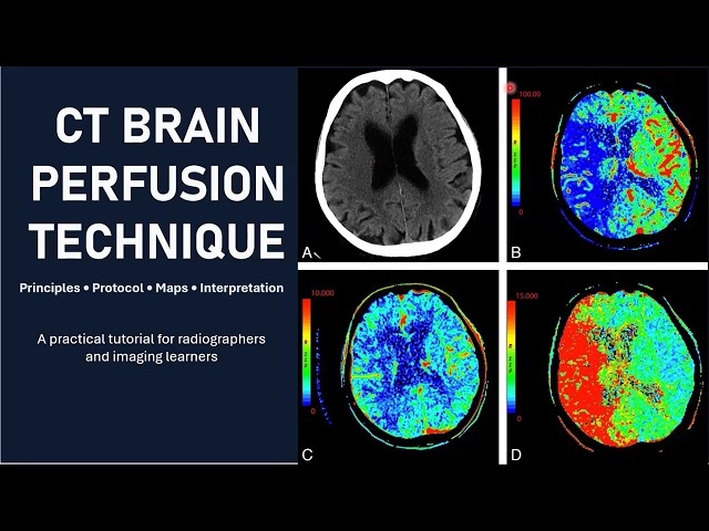CT Brain Perfusion (CTP) | Complete Tutorial for Radiographers |CBF, CBV, MTT, Tmax, Core & Penumbra