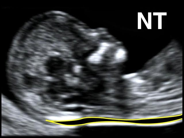 How to perform Nuchal Translucency Scan