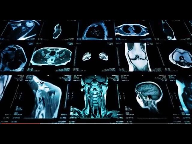 Augmenting Radiology with AI