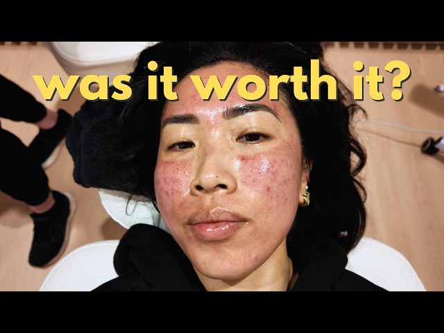 pov: you tried microneedling for acne scarring