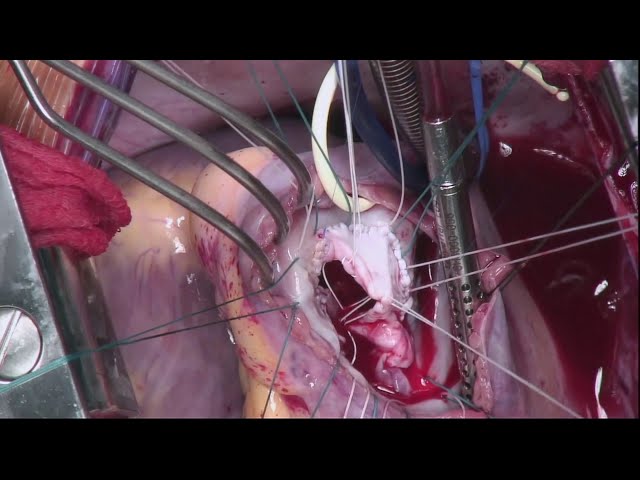 Tricuspid Valve Reconstruction for Infective Endocarditis: Operative Highlights (Graphic)