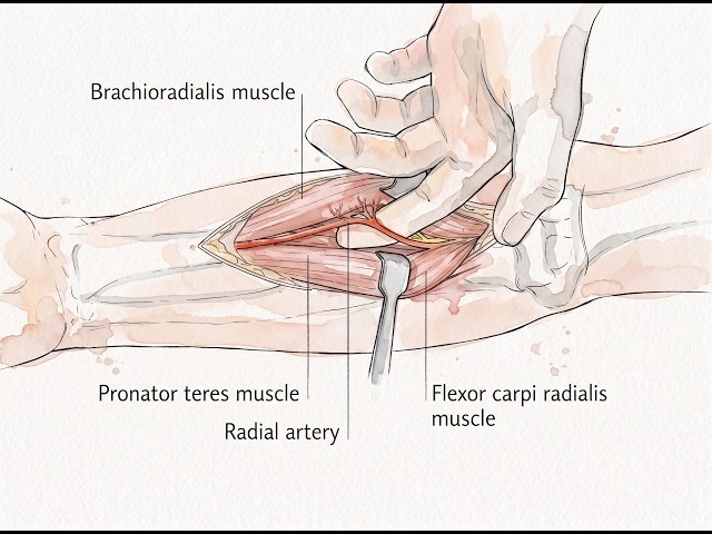 The Anterior Henry Approach: Exposure of the Entire Radial Shaft