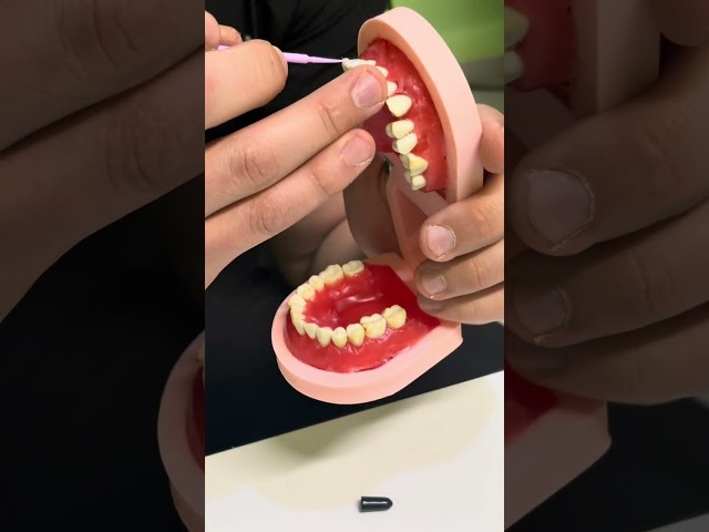 Adhesión indirecta de Brackets 