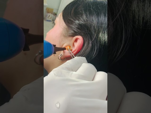 Este paciente llegó por molestia en el oído … y encontramos esto 😮#lavadodeoidos#cera#oidosano