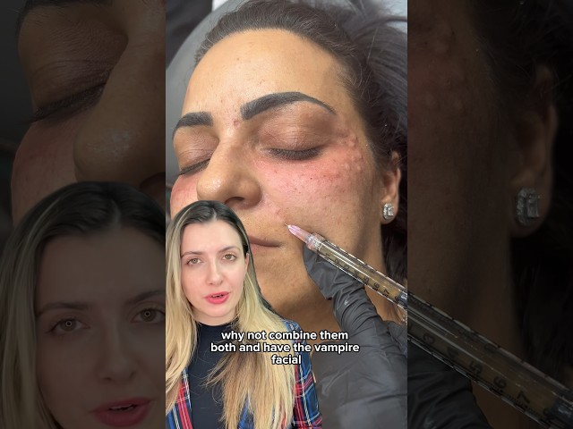 PRP MICRONEEDLING VS. PRP INJECTION | Dr. Medispa