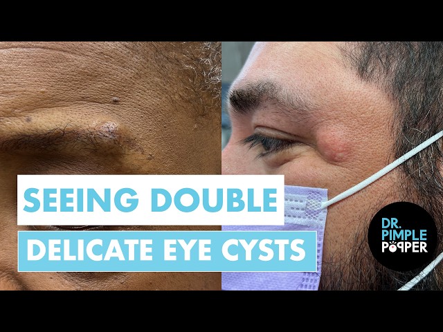 SEEING DOUBLE | Dr. Pimple Popper Removes Delicate Eye Cysts