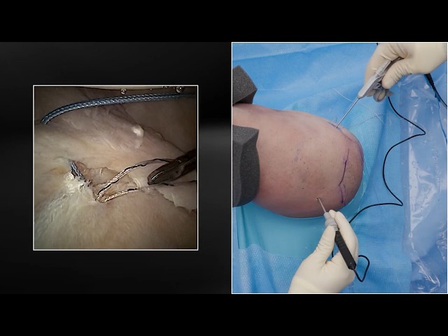 Labral Repair Using the NanoNeedle™ Scope 2.0 and the PassPort Button™ Cannula With Auxiliary Lumen