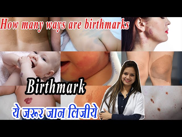 Types of Birthmarks || Know which birthmarks are harmful | Dr Suman Agarwal