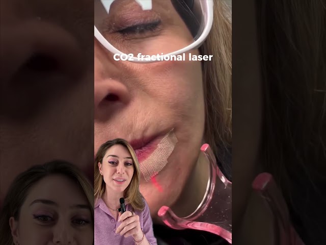 Láser de CO2 para las arrugas alrededor de la boca #co2laser #arrugas #dermatólogo