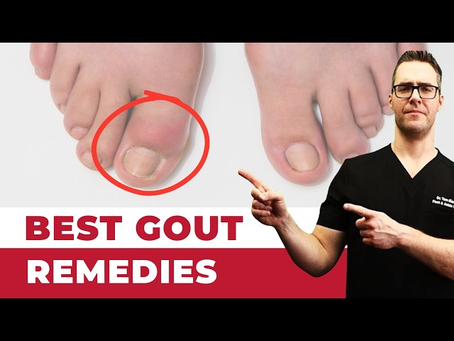 🔥What is Gout? TRUE Causes & Treatments! [Symptoms, Diet & Diagnosis]