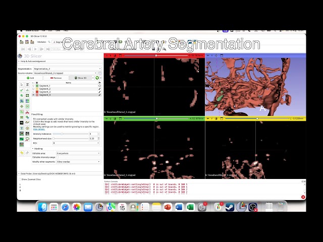 3D Slicer: Cerebral Artery Segmentation from zero