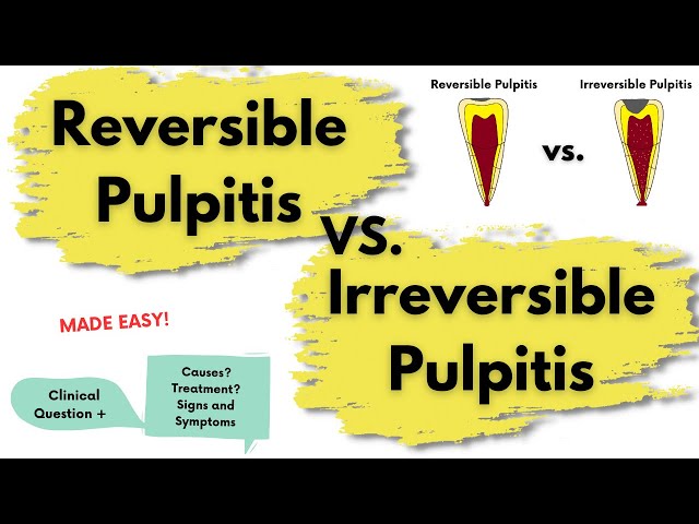 Pulpitis reversible vs. Pulpitis irreversible | Endodoncia