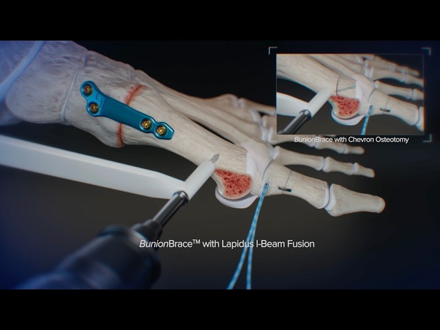 BunionBrace™ Medial Capsule Repair