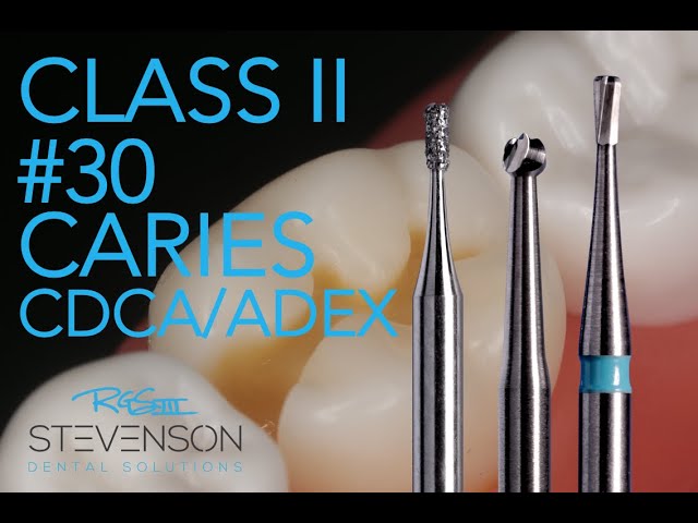 Class II Amalgam Preparation #30 MO CARIES!  | Dr. Richard Stevenson