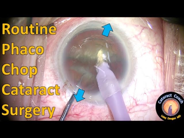 Routine Phaco Chop Cataract Surgery