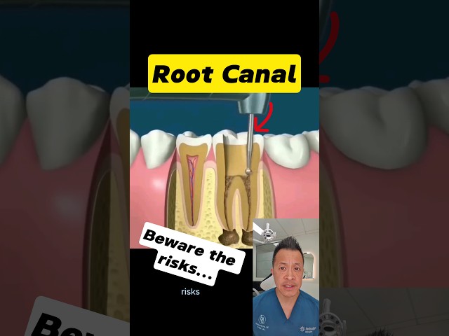 Root Canal Dangers: What Your Dentist Might Not Tell You #dentallan #dentist #shorts