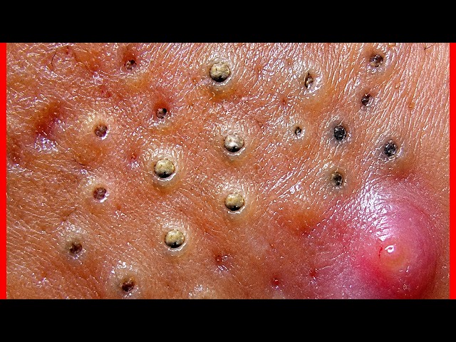 3.6.9 Blackheads Removal | How to get Rid of Blackheads on the fac | ACNE Treatment #64