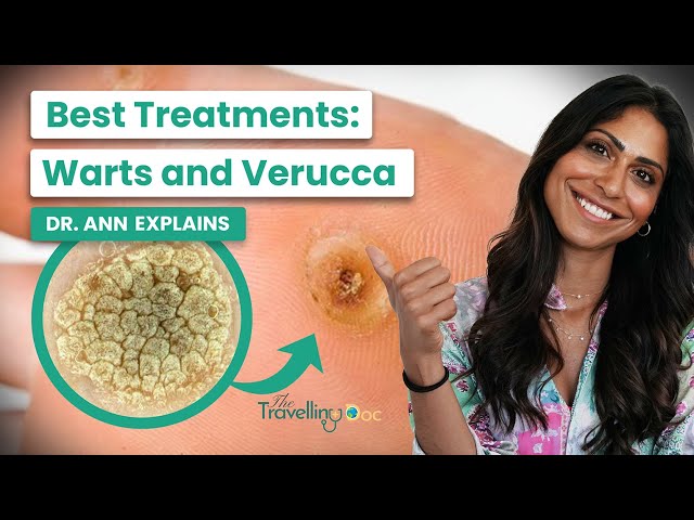 Wart & Verruca Removal: What Works (Doctor Explains)