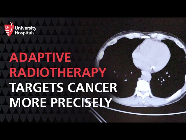 Adaptive Radiotherapy for Cancer Patients