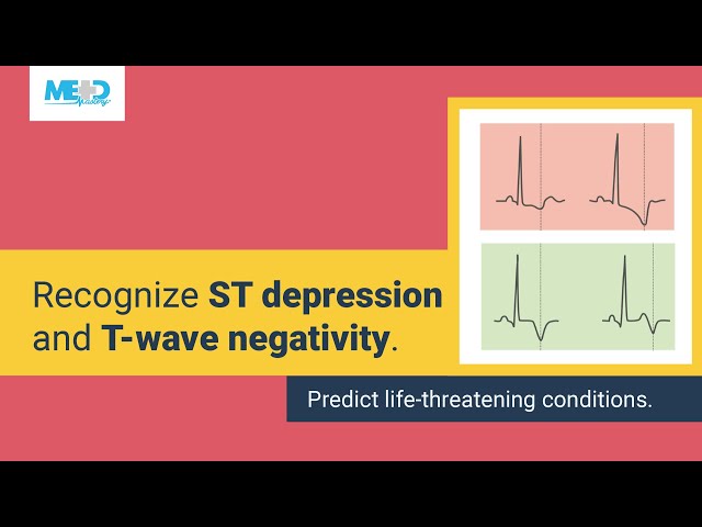 Simplifying ST depression and T-wave negativity