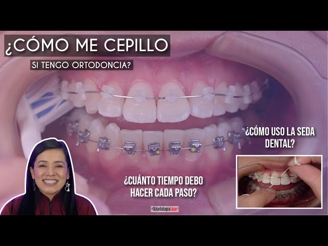 How do I brush my teeth if I have braces? 🤔 What should I use? 😬 #OralRoutineWithOrthodontics - L...