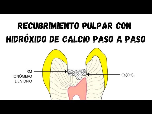 Step-by-Step Pulp Capping with Calcium Hydroxide