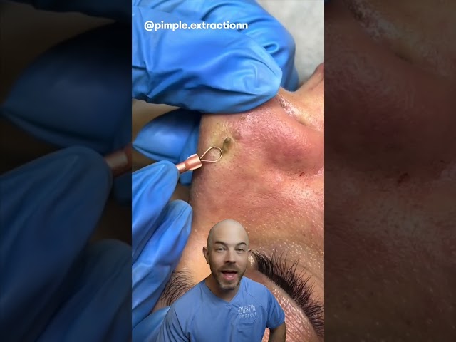 This pop has perfect technique!🍾 (credit: @pimple.extractionn on TT) #doctor #satisfying #viral