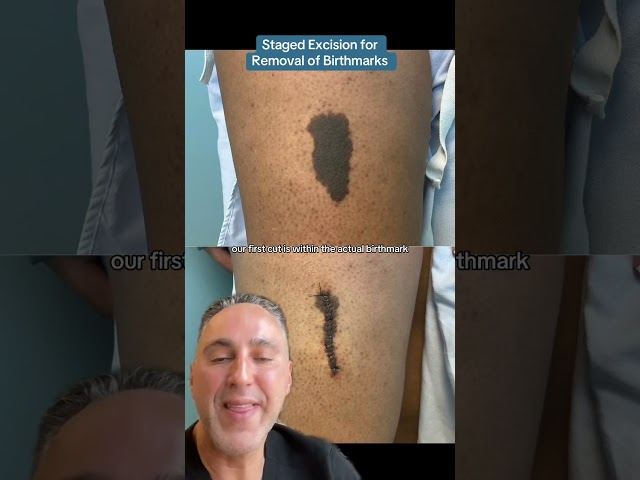 Staged Excision for Removal of Birthmarks