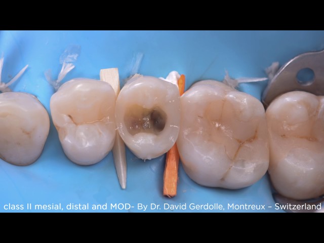 Class II Mesial, Distal and MOD using myClip 2.0 - Dr. Gerdolle