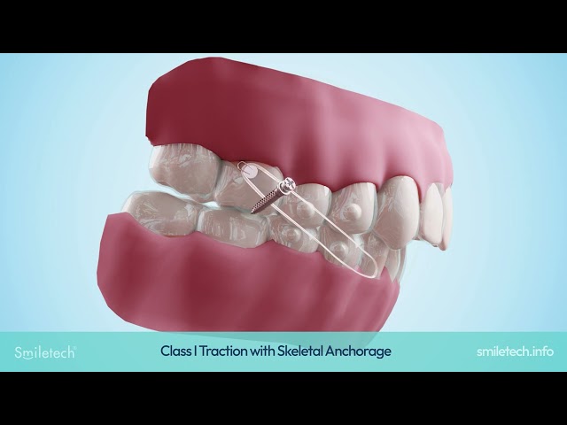 Smiletech Elastic Traction