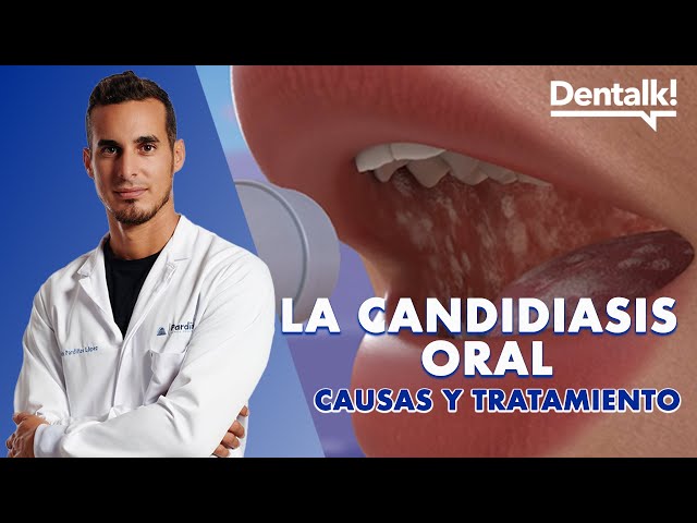 Oral Fungus? Causes, Prevention, and Treatment of Oral Candidiasis and Angular Cervical Ulcers | ...