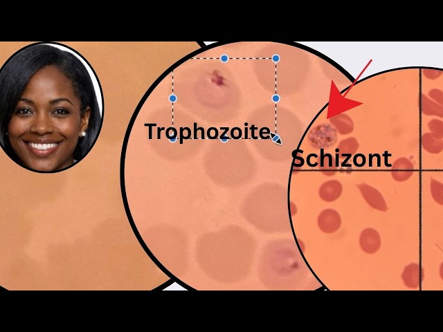MALARIA MICROSCOPY  | plasmodium  falciparum morphology | Lab diagnosis- Parasitology