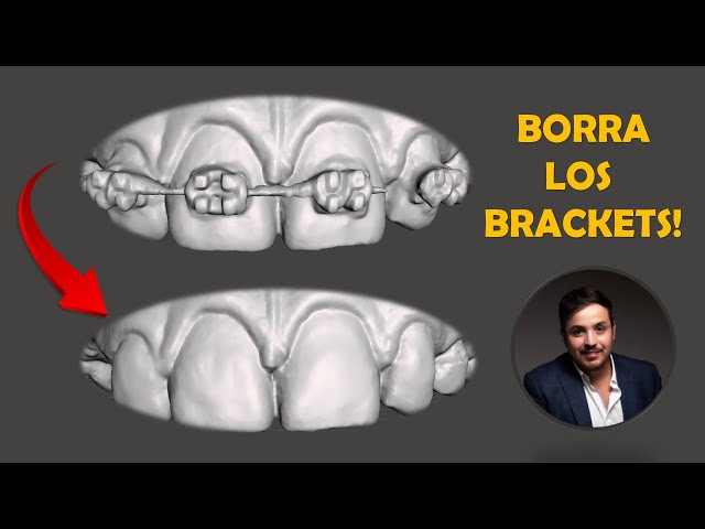 BORRADO DE BRACKETS EN MESHMIXER