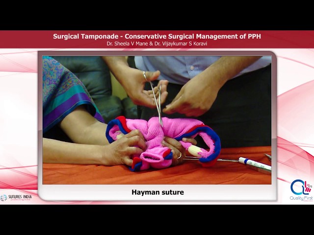 Surgical Management of PPH by Dr. Sheela Mane