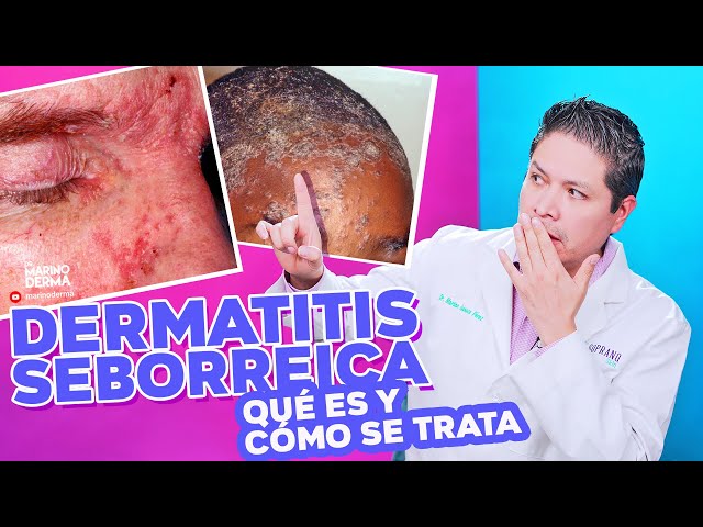 DERMATITIS SEBORREICA. ¿QUE ES Y COMO SE TRATA?. Tips de un dermatologo