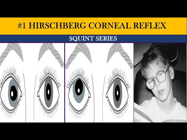 Phoria v/s tropia | types of squint | Hirschberg Corneal Reflex Test (HCRT) | Squint series