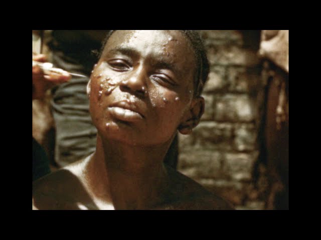 African Trypanosomiasis (U.S. Naval Photographic Center, 1951)