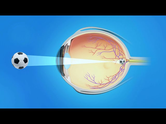 Nearsightedness (Myopia)